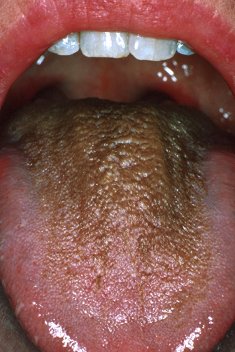 Hairy Tongue in Adults: Condition, Treatments, and ...